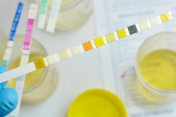 Urine sample with test strip identifier.