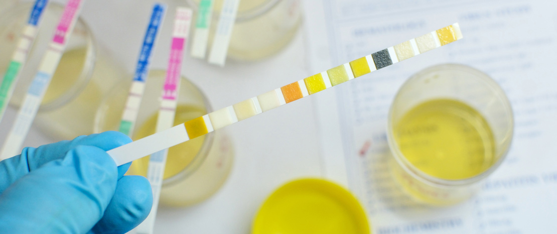 Urine analysis dipstick and urine vials from Express Lab.